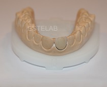 korona porcelanowa na stali
